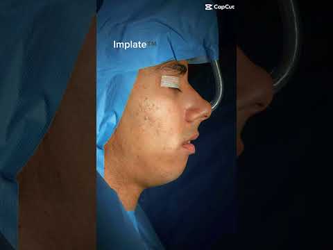 When jaw surgery meets the aesthetic implant for mandible definition #implate #jawsurgery